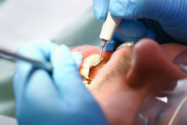 Best Root Canal Emergency Dentist  in Marion, IA